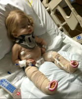 Criança com fraturas múltiplas devido Osteogenesis Imperfeita